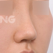 비염수술코성형 동시에 가능할까요? 사진 6
