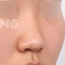 비염수술코성형 동시에 가능할까요? 사진 3