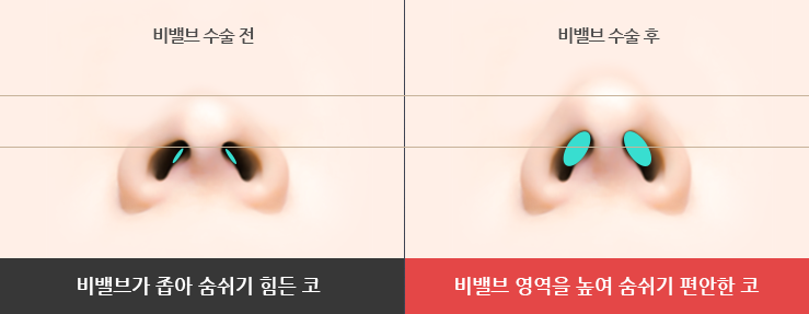 비중격만곡증 재발 반복되는 코막힘 재수술 시점 사진 4