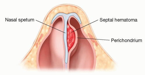 코 부딪히고 코피 골절 의심 시 진행 순서 사진 4
