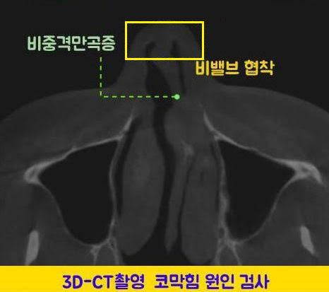 매부리코 성형수술 필러와 절골 사이 선택 기준 사진 5