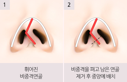 코뼈 휨 비중격까지 틀어졌다면 보험 적용될까 사진 4