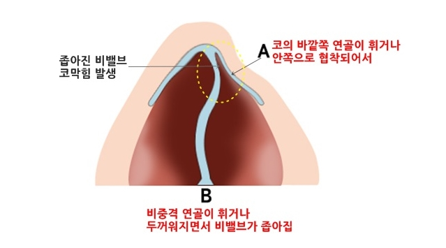 비염수술 잘하는곳 비용만큼 챙길 부작용 여부