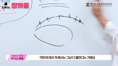 [제이준성형외과·피부과] 쌍꺼풀 수술 vs 쌍꺼풀+눈매교정! 눈매교정 함께 하면 좋은 이유! 사진 6