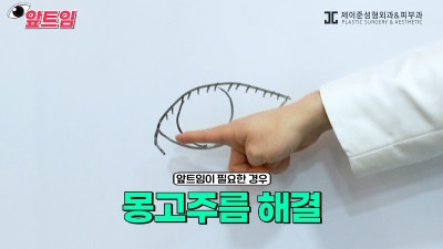 [제이준성형외과·피부과] 앞트임, 왜 필요할까? 앞트임의 모든 것!! 사진 15
