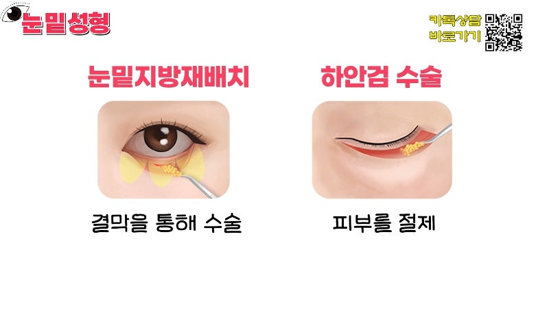 [제이준성형외과·피부과] 하안검? 눈밑지방재배치? 이것만 보고 결정하세요! 사진 11