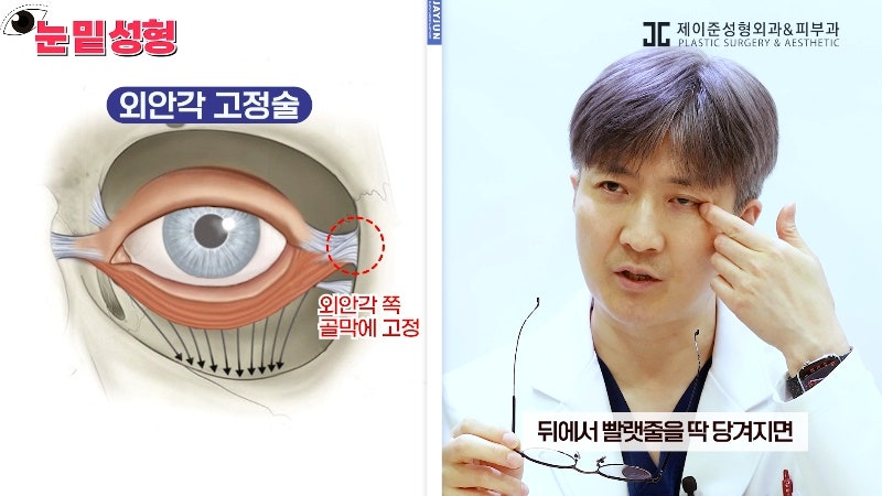 [제이준성형외과·피부과] 하안검? 눈밑지방재배치? 이것만 보고 결정하세요! 사진 15