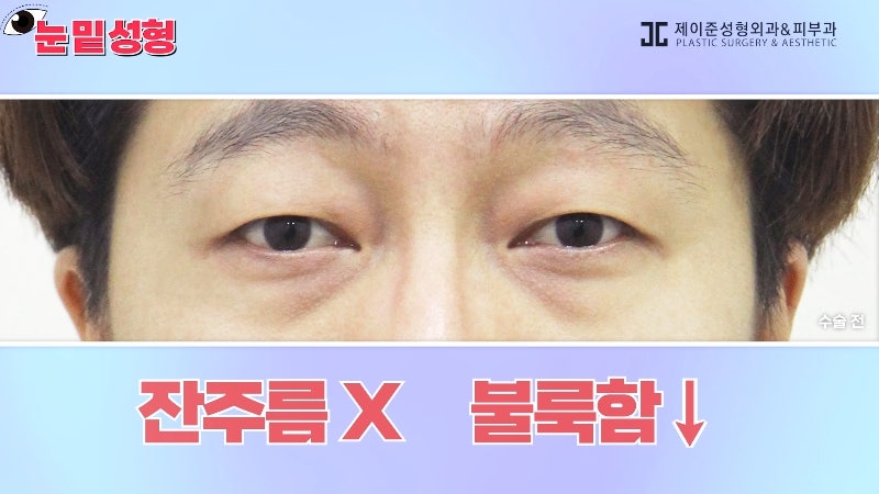 [제이준성형외과·피부과] 하안검? 눈밑지방재배치? 이것만 보고 결정하세요! 사진 22