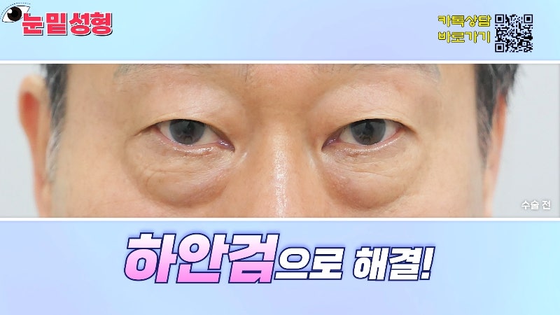 [제이준성형외과·피부과] 하안검? 눈밑지방재배치? 이것만 보고 결정하세요! 사진 27