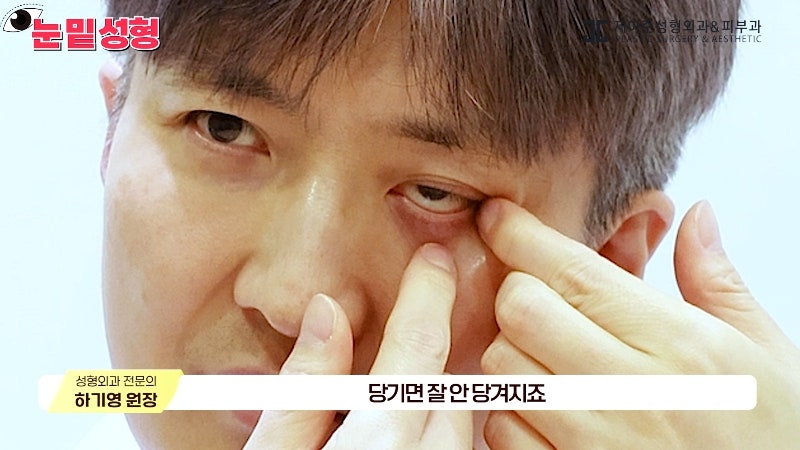 [제이준성형외과·피부과] 하안검? 눈밑지방재배치? 이것만 보고 결정하세요! 사진 17
