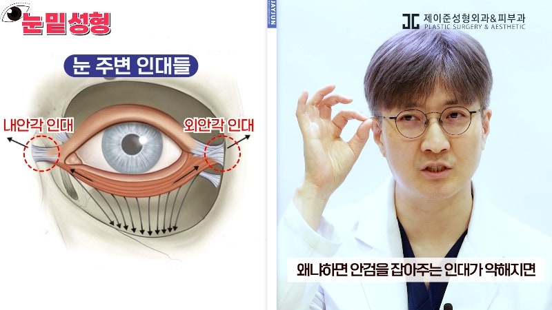 [제이준성형외과·피부과] 하안검? 눈밑지방재배치? 이것만 보고 결정하세요! 사진 12