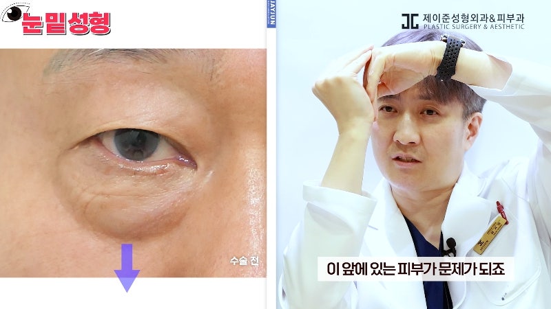 [제이준성형외과·피부과] 하안검? 눈밑지방재배치? 이것만 보고 결정하세요! 사진 7
