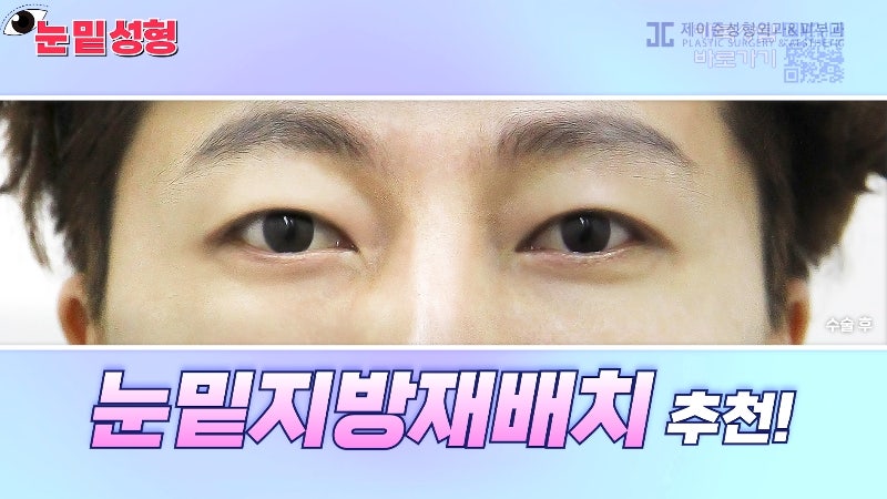 [제이준성형외과·피부과] 하안검? 눈밑지방재배치? 이것만 보고 결정하세요! 사진 23