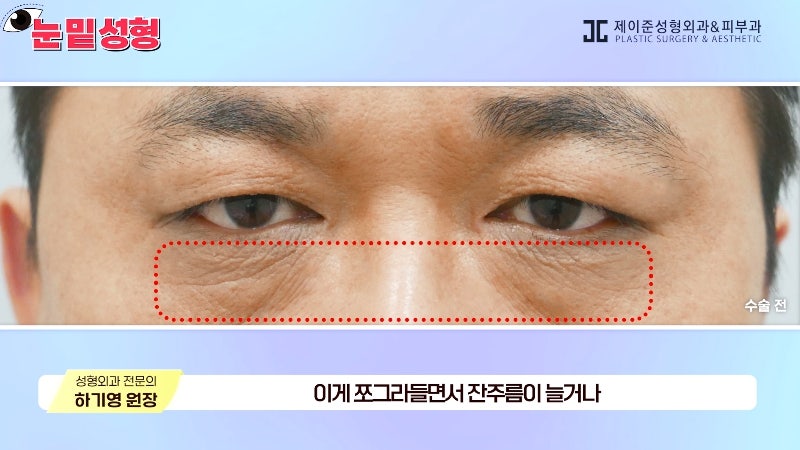 [제이준성형외과·피부과] 하안검? 눈밑지방재배치? 이것만 보고 결정하세요! 사진 8