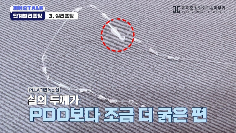 [제이준성형외과·피부과] 보톡스부터 안면거상까지, 내 처짐 수준에 맞는 리프팅 선택법 사진 16
