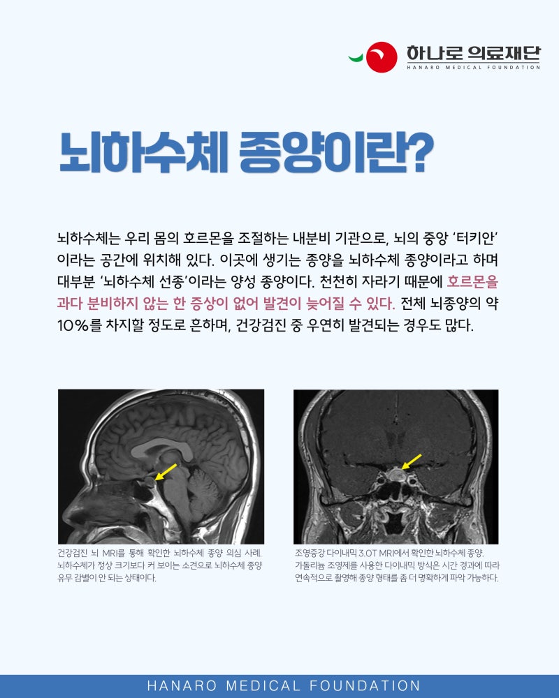 흔하지만 잘 모르는 '뇌하수체 종양'