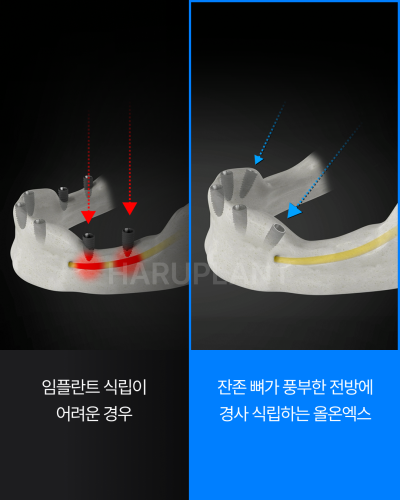 올온엑스 임플란트, 전악 임플란트가 어렵다고 들은 경우에도 고려할 수 있는 이유는? 사진 8