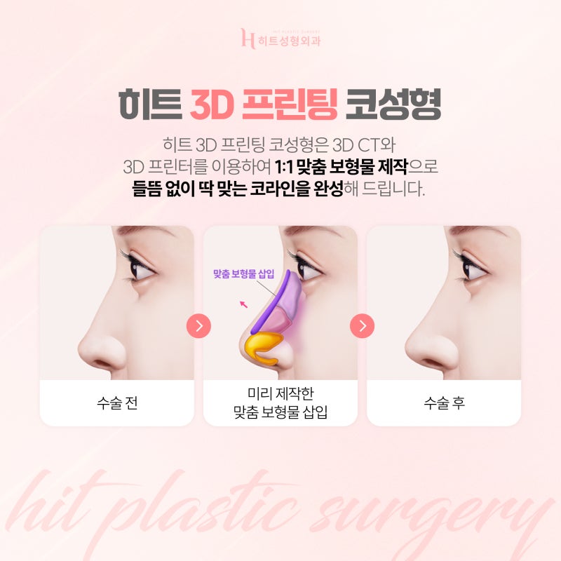 [히트성형외과] 코수술, 어떤 라인이 나에게 어울릴까? 사진 3