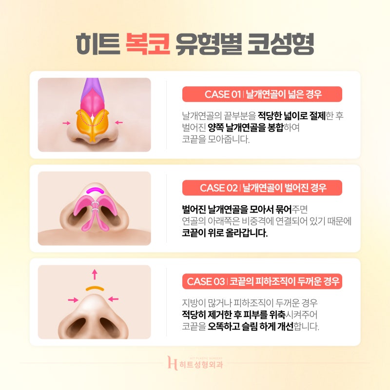 [히트성형외과] 내 코에 맞는 코수술은? 유형별 코수술
