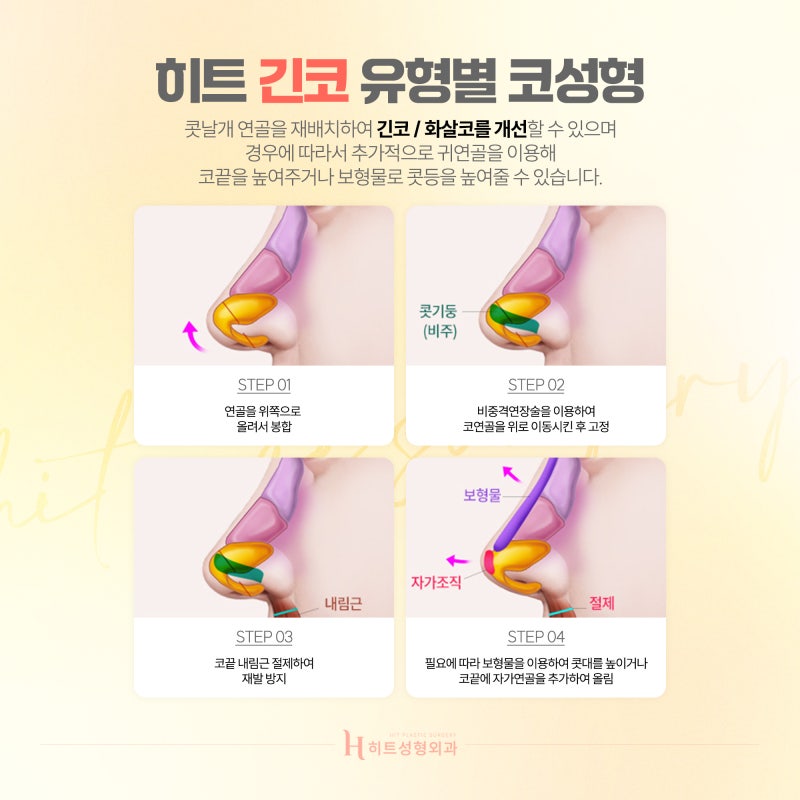 [히트성형외과] 내 코에 맞는 코수술은? 유형별 코수술 사진 5