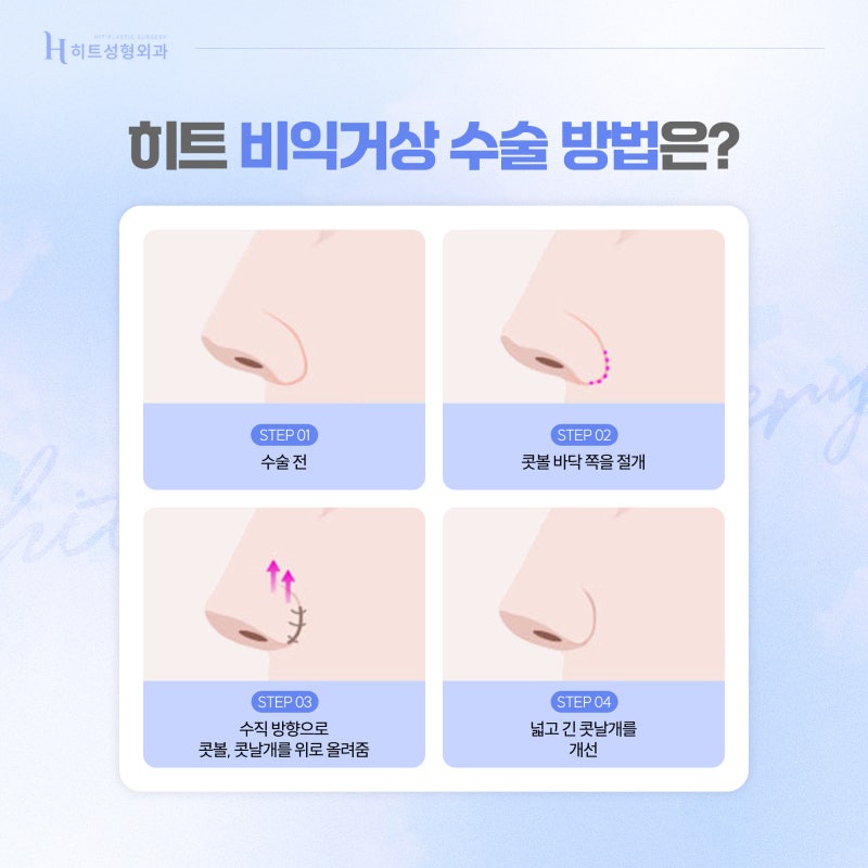 [히트성형외과] 콧볼축소의 모든 것! 비익거상과 비공내리기 사진 4
