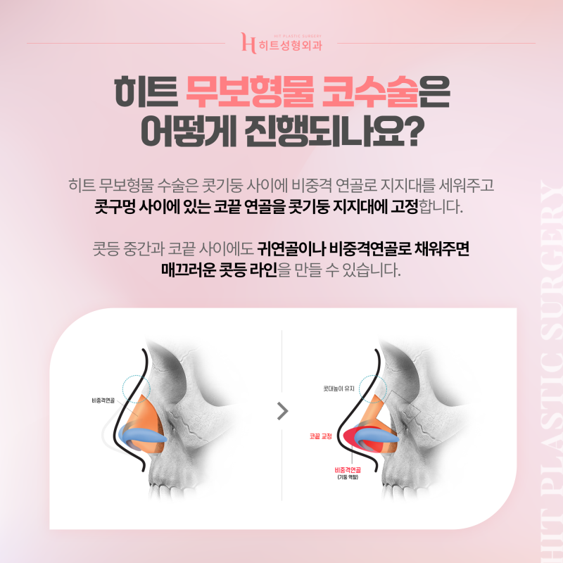 [히트성형외과] 자가 조직만으로 세련되게, 무보형물 코수술 사진 4