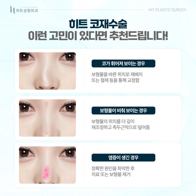 [히트성형외과] 아름다움과 기능까지, 만족스러운 코재수술 사진 5