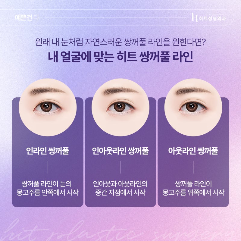 [히트성형외과] 쌍꺼풀 라인, 화려하게 또는 자연스럽게 사진 3