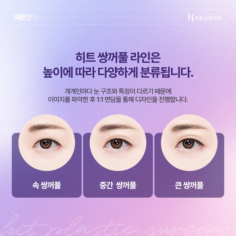 [히트성형외과] 쌍꺼풀 라인, 화려하게 또는 자연스럽게 사진 4