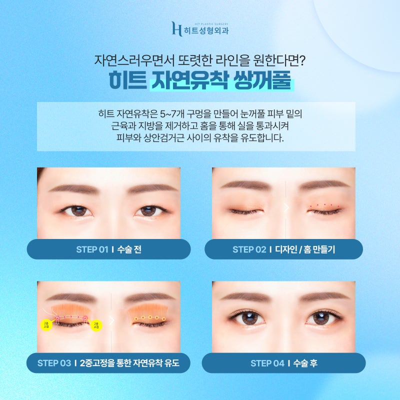 [히트성형외과] 나에게 맞는 쌍꺼풀 수술법은 뭘까 궁금하다면? 사진 2