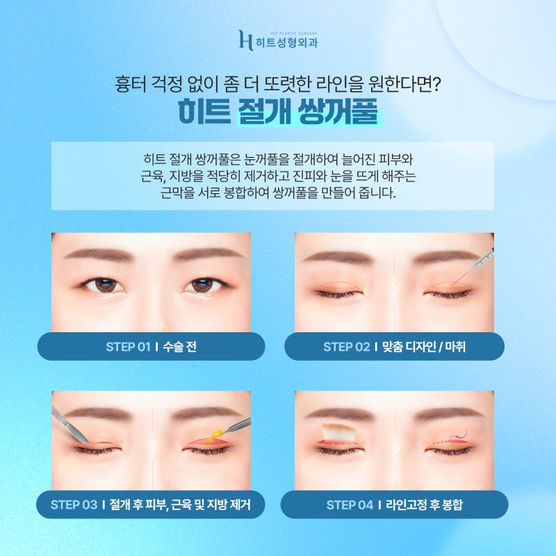 [히트성형외과] 나에게 맞는 쌍꺼풀 수술법은 뭘까 궁금하다면? 사진 4