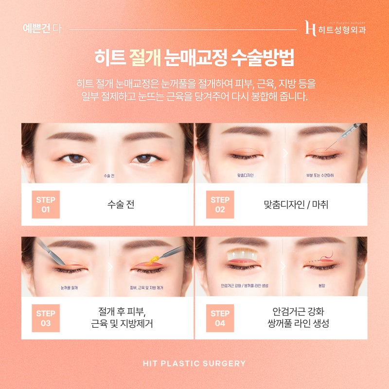 [히트성형외과] 작고 흐릿한 눈매, 히트 눈매교정으로 더 또렷하게 사진 5
