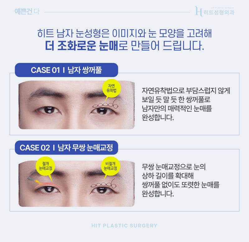 [히트성형외과] 티나지 않는 자연스러움, 남자 눈성형