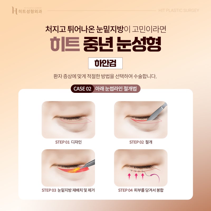[히트성형외과] 중년 눈성형이 중요한 이유 사진 4