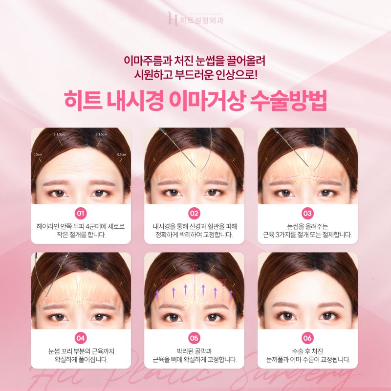 [히트성형외과] 이마부터 눈꺼풀까지 한번에, 내시경 이마거상 사진 5