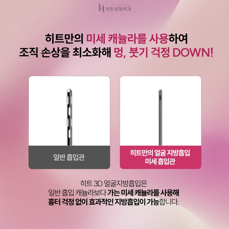 [히트성형외과] 숨어있던 V라인 되찾고 싶다면? 3D 얼굴지방흡입 사진 4