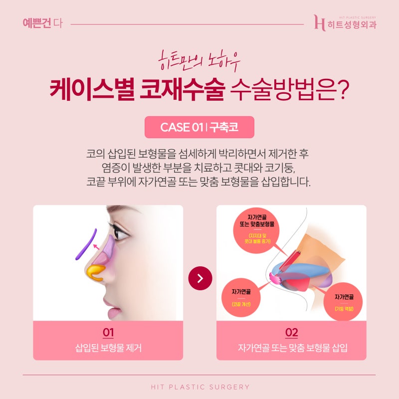 [히트성형외과] 오직 나를 위한 맞춤 보형물, 3D프린팅 코재수술 사진 3