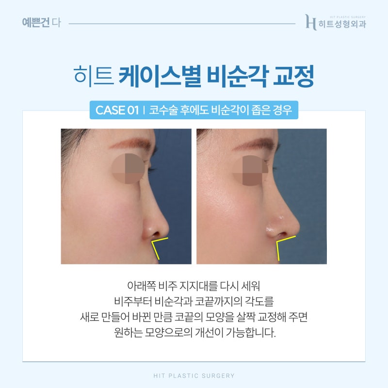 [히트성형외과] 이상적인 코 라인을 위한 히트 비순각 교정 사진 3