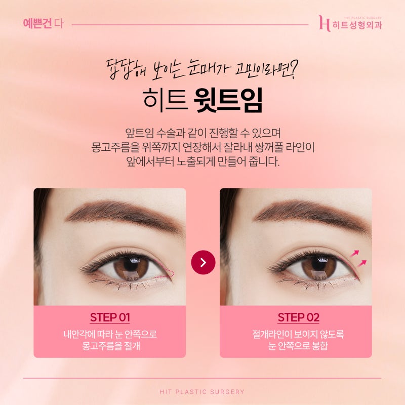 [히트성형외과] 트임 성형, 보다 더 시원한 눈매로 사진 3