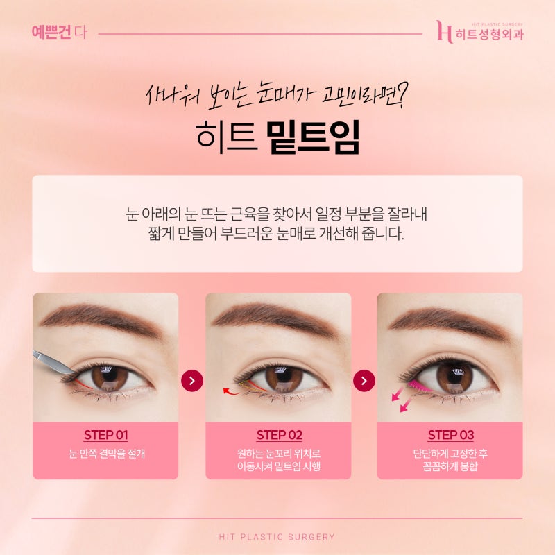 [히트성형외과] 트임 성형, 보다 더 시원한 눈매로 사진 5