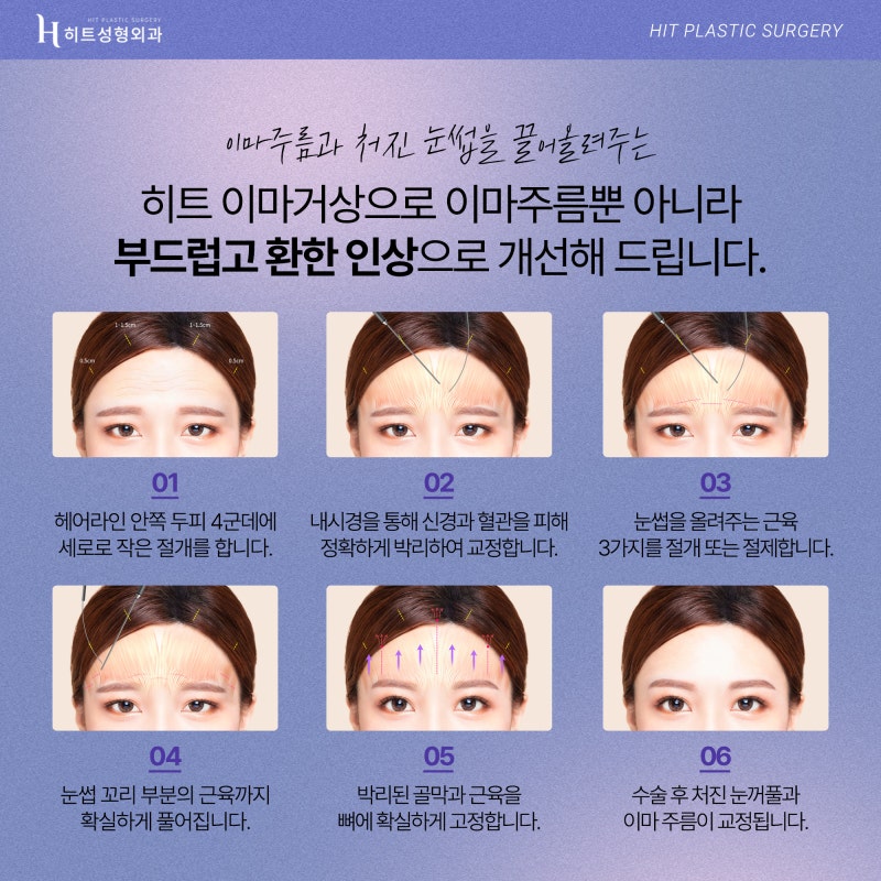 [히트성형외과] 처진 눈을 위한 또 다른 개선방법, 히트 이마거상 사진 5