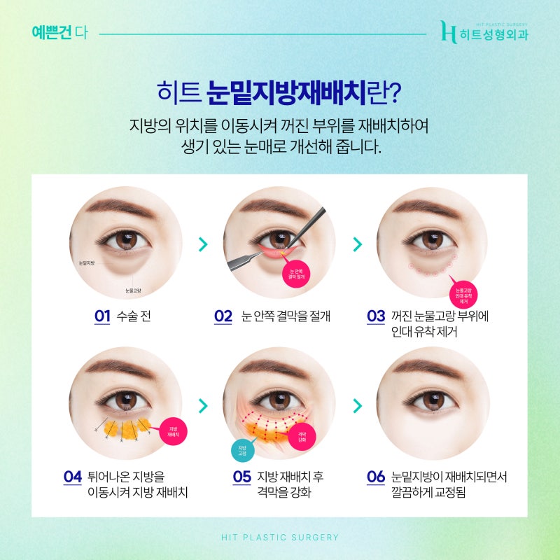 [히트성형외과] 눈밑지방재배치와 하안검, 어떤 차이일까? 사진 3