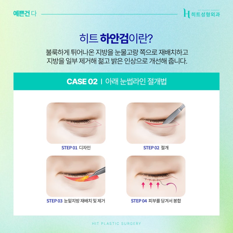 [히트성형외과] 눈밑지방재배치와 하안검, 어떤 차이일까? 사진 5