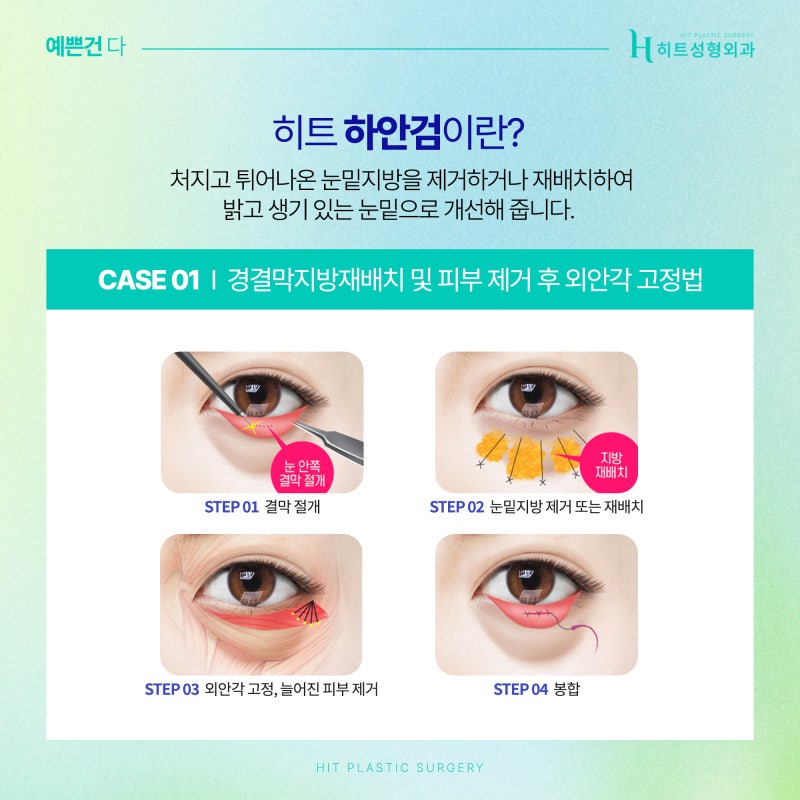 [히트성형외과] 눈밑지방재배치와 하안검, 어떤 차이일까? 사진 4