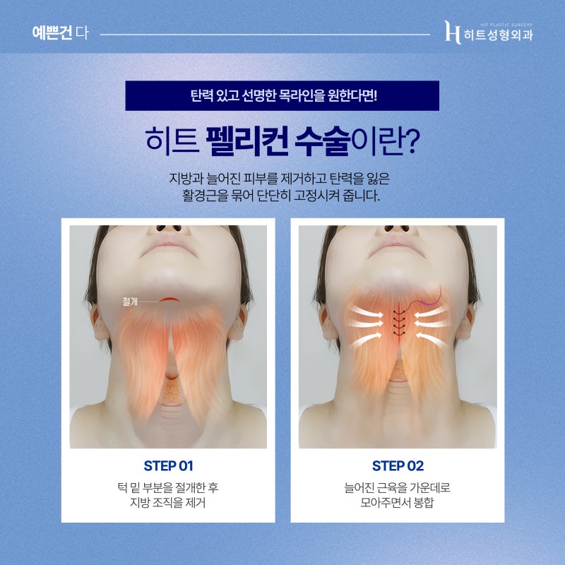 [히트성형외과] 늘어진 이중턱이 고민이라면? 얼굴지방흡입+펠리컨 수술