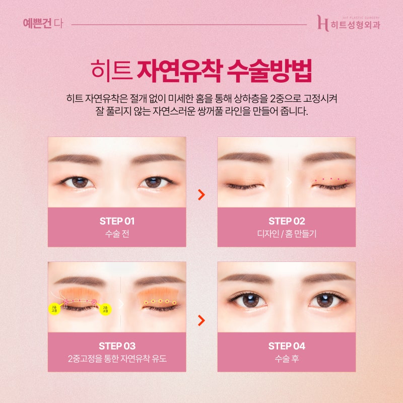 [히트성형외과] 자연유착 쌍꺼풀 더욱 또렷하고 자연스럽게! 사진 4