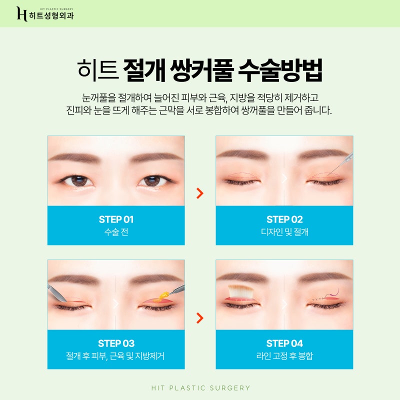 [히트성형외과] 확실한 라인을 위한 히트 절개 쌍꺼풀! 사진 4