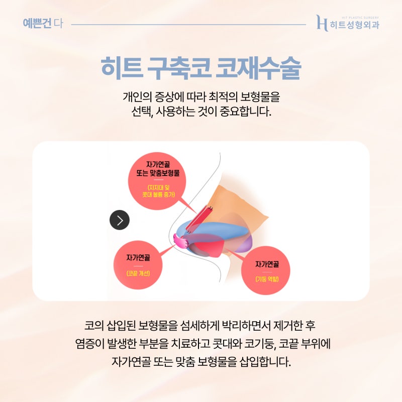 [히트성형외과] 구축코, 3D 맞춤보형물로 완성도 높은 코재수술! 사진 3