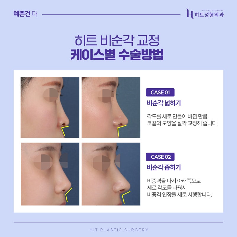 [히트성형외과] 코성형 시 비순각 교정을 해야하는 이유 사진 5