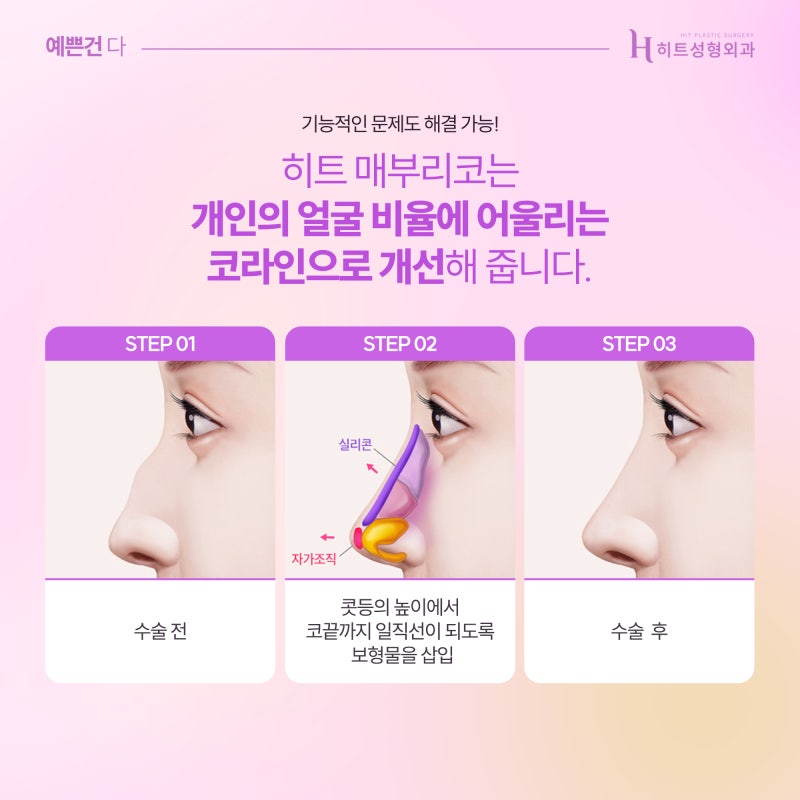 [히트성형외과] 코 뼈를 깎지 않는 매부리코 수술법! 사진 4